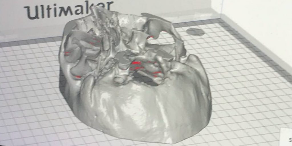 Impresión 3D médica